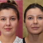 Neck & Face Liposuction Before & After Patient #14905