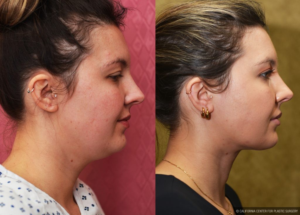 Neck & Face Liposuction Before & After Patient #14905