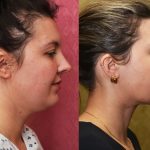 Neck & Face Liposuction Before & After Patient #14905