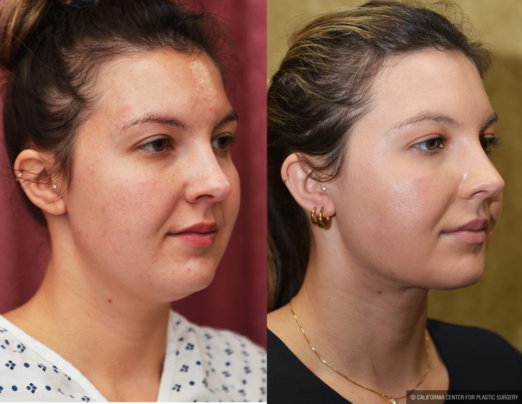 Neck & Face Liposuction Before & After Patient #14905