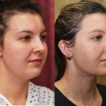 Neck & Face Liposuction Before & After Patient #14905