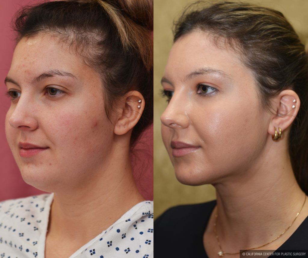 Neck & Face Liposuction Before & After Patient #14905