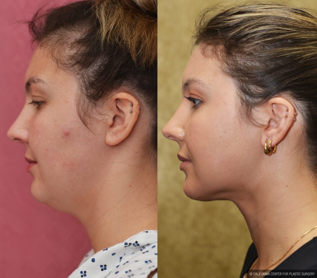 Neck & Face Liposuction Before & After Patient #14905
