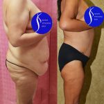 Tummy Tuck (Abdominoplasty) Plus Size Before & After Patient #14914
