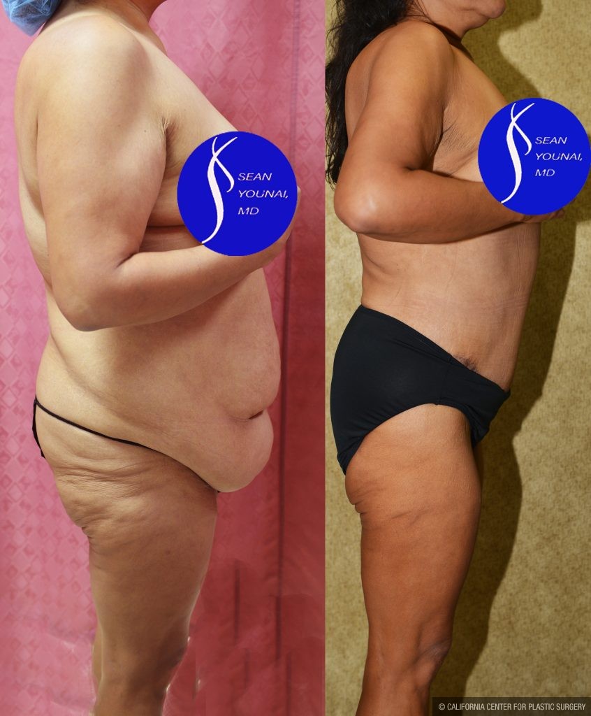 Tummy Tuck (Abdominoplasty) Plus Size Before & After Patient #14914