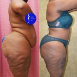African American Tummy Tuck (Abdominoplasty) Before & After Patient #14913