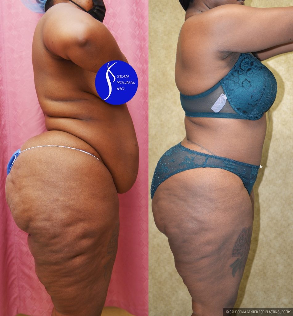 African American Tummy Tuck (Abdominoplasty) Before & After Patient #14913