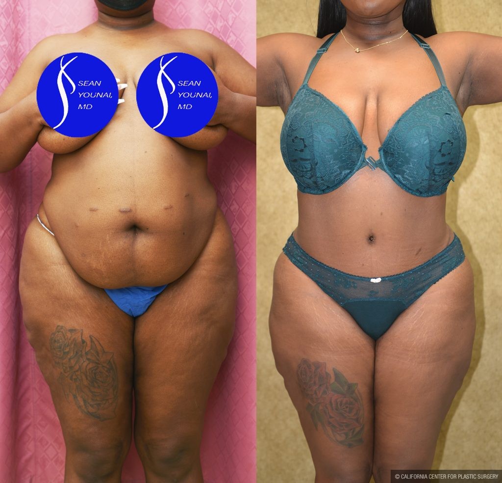 African American Tummy Tuck (Abdominoplasty) Before & After Patient #14913