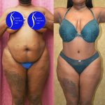 African American Tummy Tuck (Abdominoplasty) Before & After Patient #14913