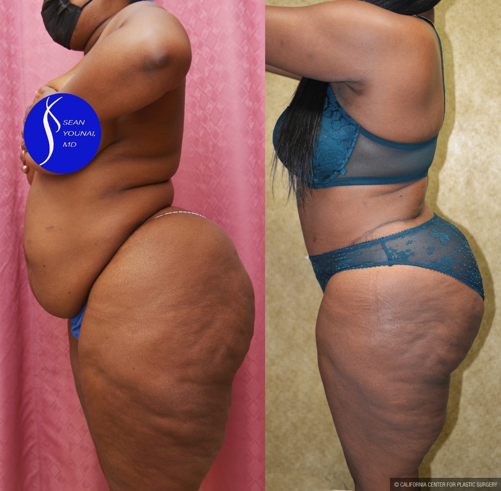 African American Tummy Tuck (Abdominoplasty) Before & After Patient #14913