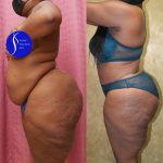 African American Tummy Tuck (Abdominoplasty) Before & After Patient #14913