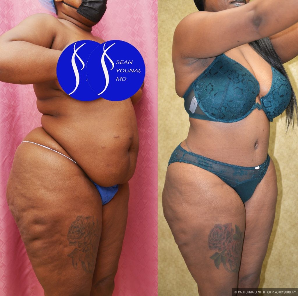 African American Tummy Tuck (Abdominoplasty) Before & After Patient #14913