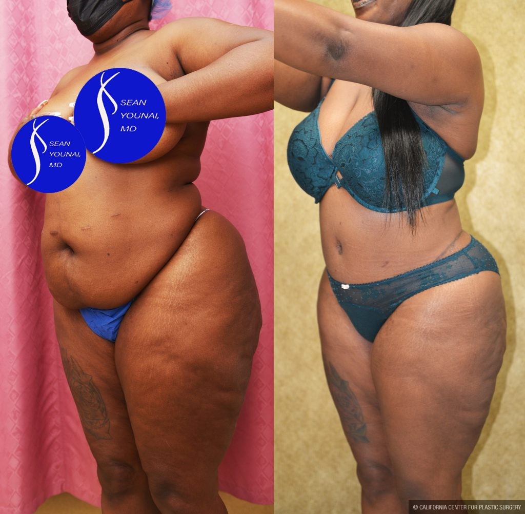 African American Tummy Tuck (Abdominoplasty) Before & After Patient #14913