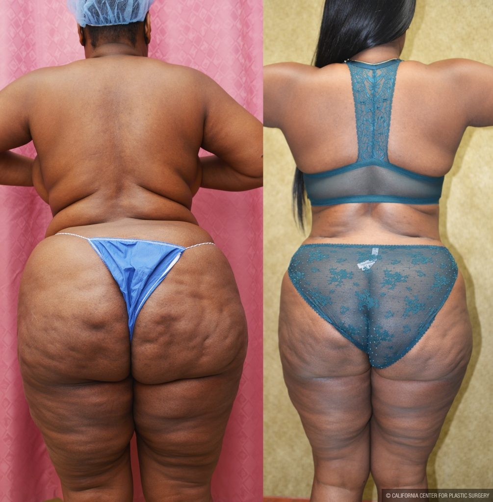 African American Tummy Tuck (Abdominoplasty) Before & After Patient #14913