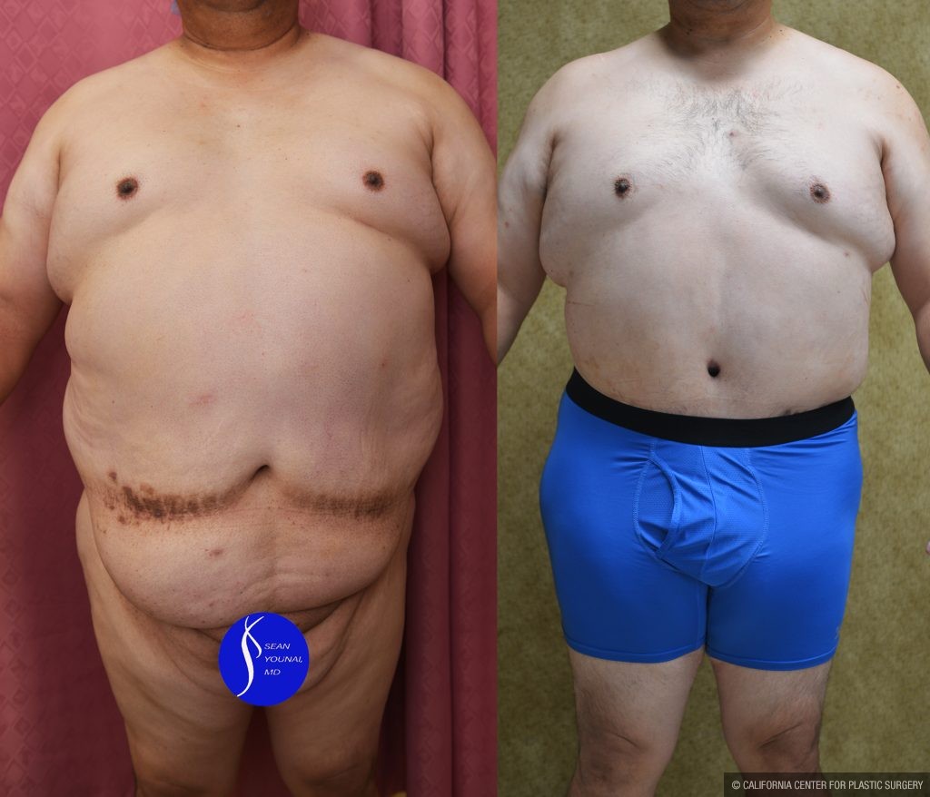 Male Tummy Tuck (abdominoplasty) Before & After Patient #14904
