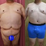 Male Tummy Tuck (abdominoplasty) Before & After Patient #14904