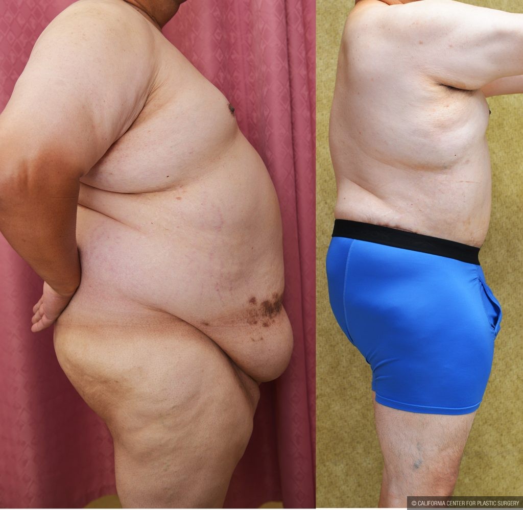 Male Tummy Tuck (abdominoplasty) Before & After Patient #14904