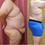 Male Tummy Tuck (abdominoplasty) Before & After Patient #14904