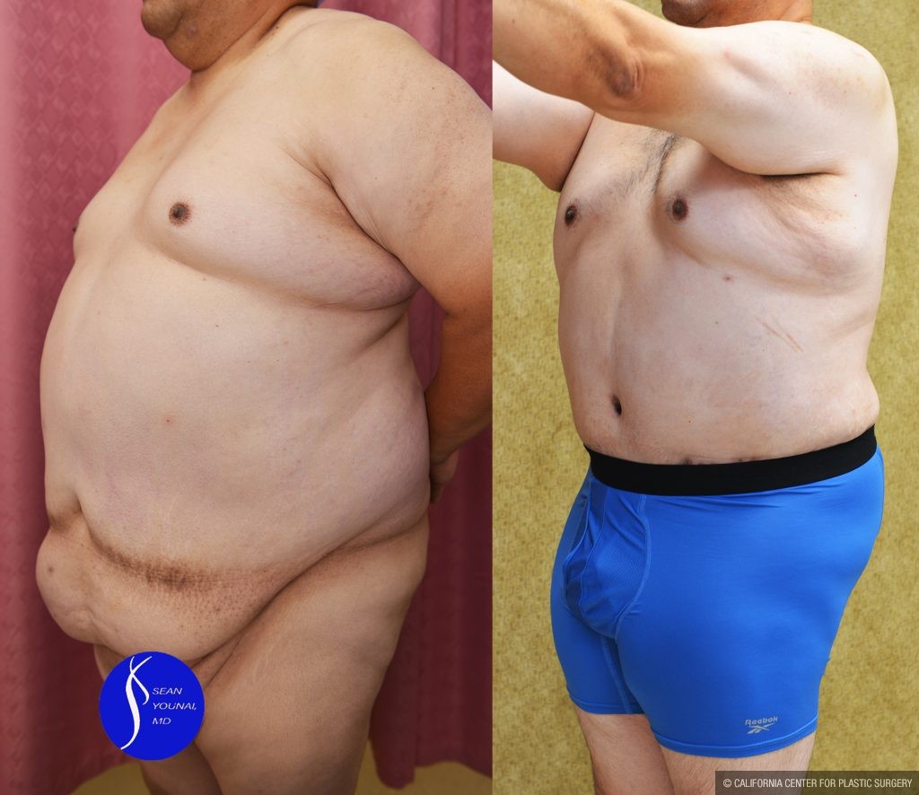 Male Tummy Tuck (abdominoplasty) Before & After Patient #14904