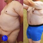 Male Tummy Tuck (abdominoplasty) Before & After Patient #14904