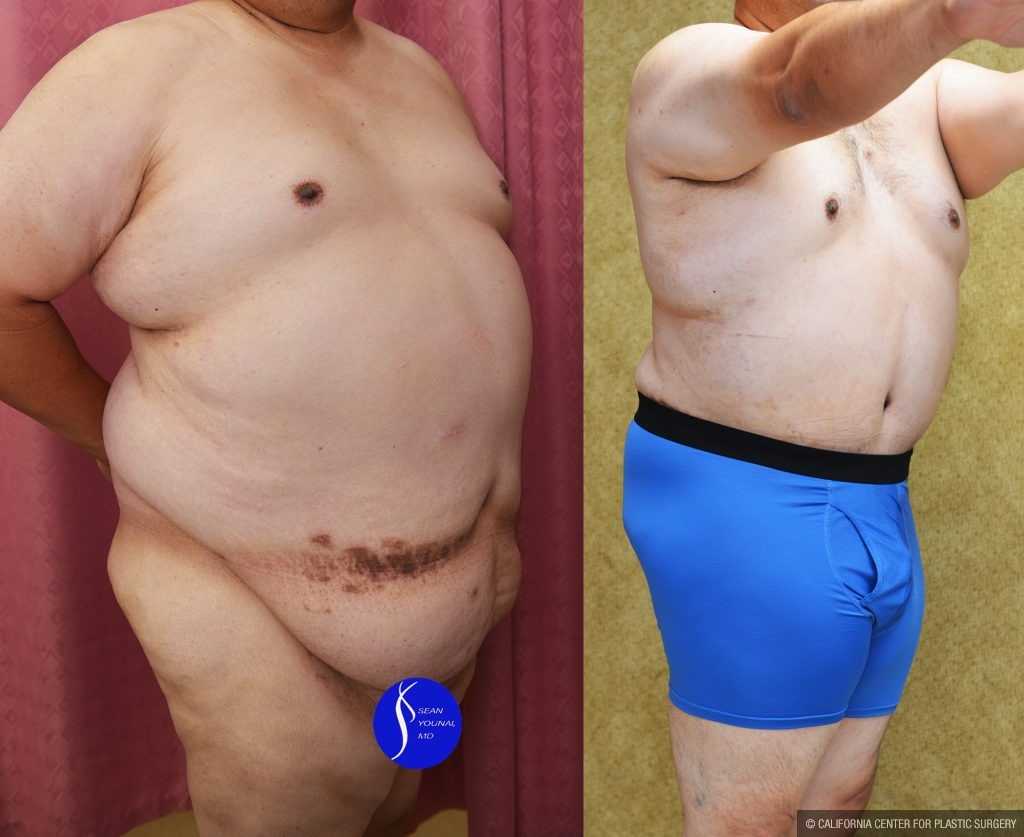 Male Tummy Tuck (abdominoplasty) Before & After Patient #14904