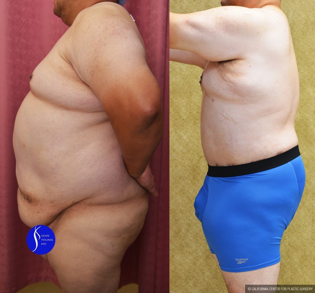 Male Tummy Tuck (abdominoplasty) Before & After Patient #14904