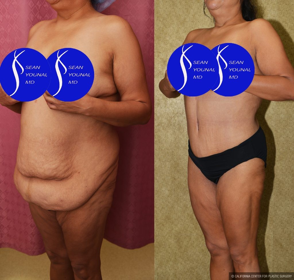 Tummy Tuck (Abdominoplasty) Plus Size Before & After Patient #14914