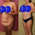 Tummy Tuck (Abdominoplasty) Plus Size Before & After Patient #14914