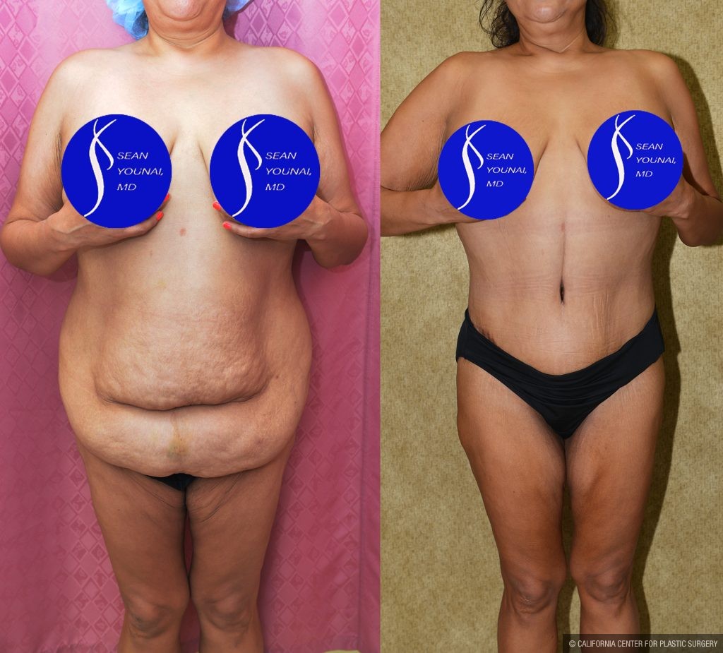 Tummy Tuck (Abdominoplasty) Plus Size Before & After Patient #14914