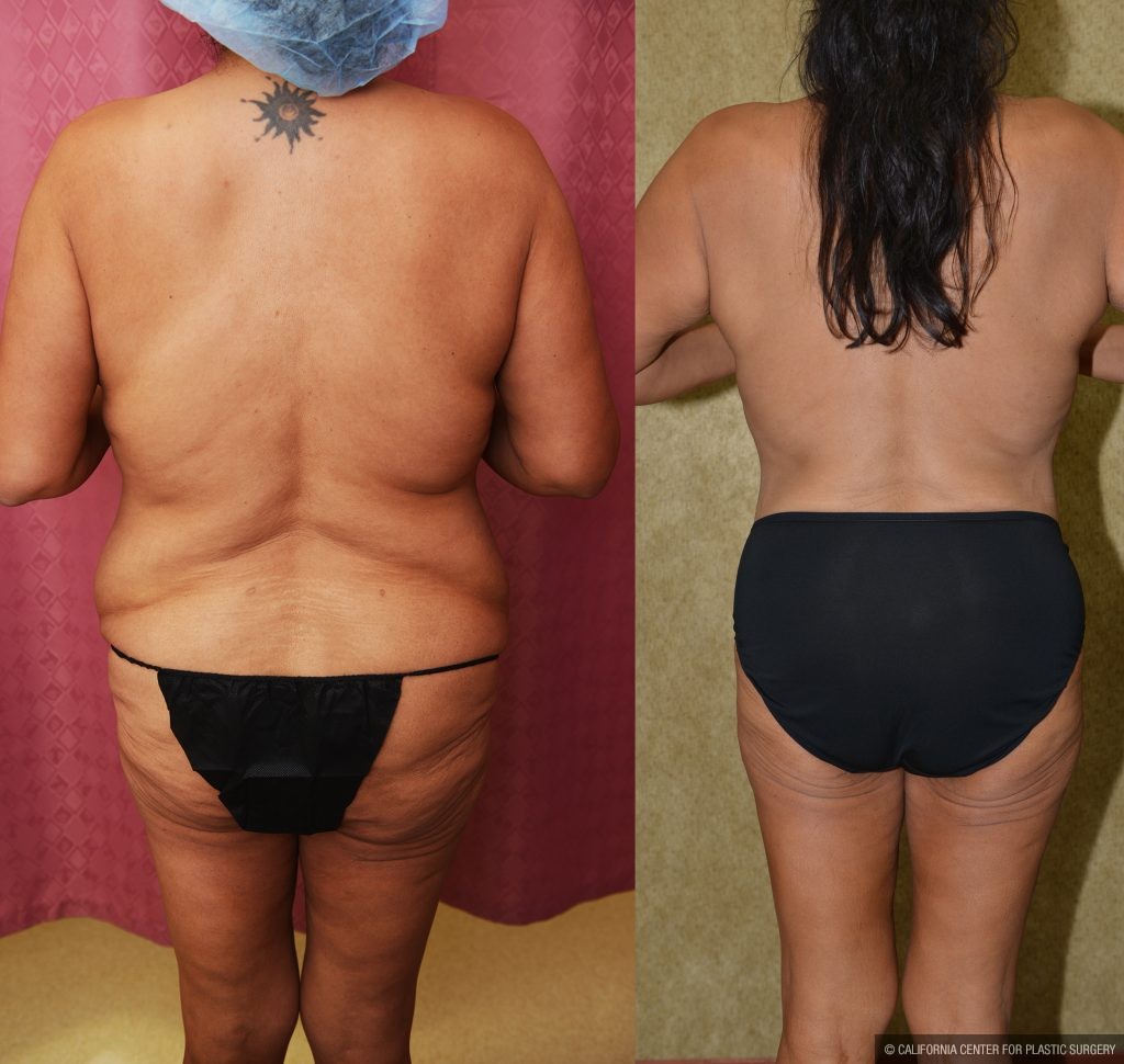 Tummy Tuck (Abdominoplasty) Plus Size Before & After Patient #14914