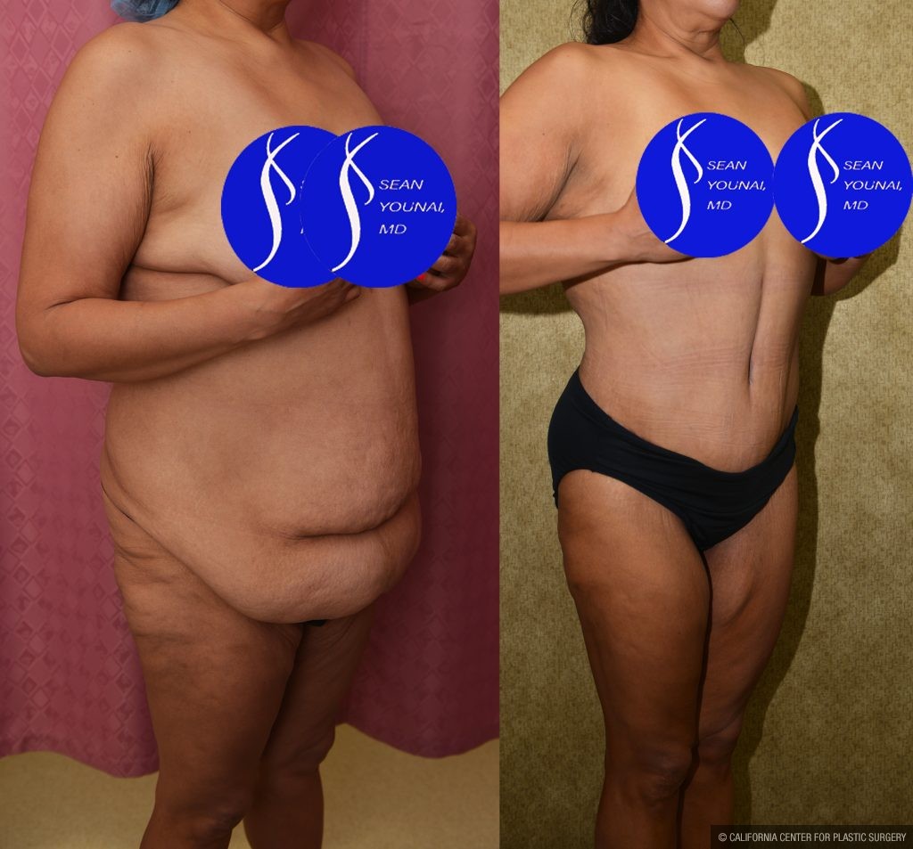 Tummy Tuck (Abdominoplasty) Plus Size Before & After Patient #14914