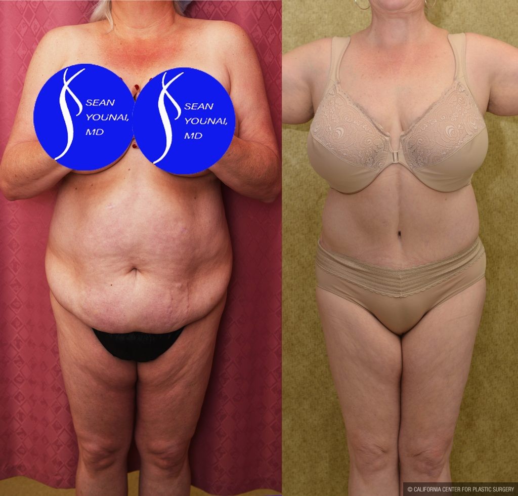Tummy Tuck (Abdominoplasty) Plus Size Before & After Patient #14915