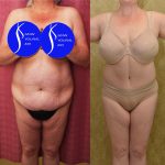 Tummy Tuck (Abdominoplasty) Plus Size Before & After Patient #14915