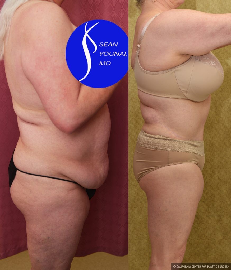 Tummy Tuck (Abdominoplasty) Plus Size Before & After Patient #14915