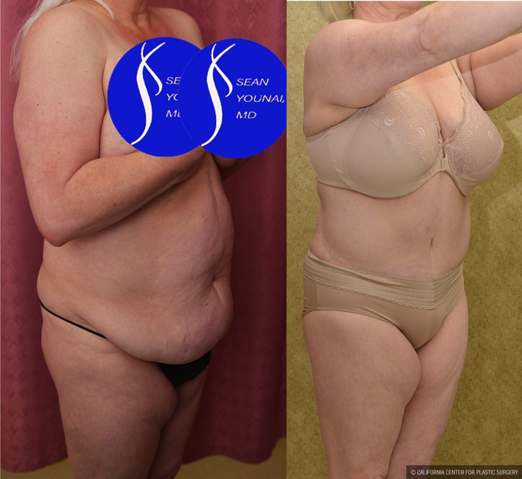 Tummy Tuck (Abdominoplasty) Plus Size Before & After Patient #14915
