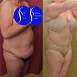 Tummy Tuck (Abdominoplasty) Plus Size Before & After Patient #14915