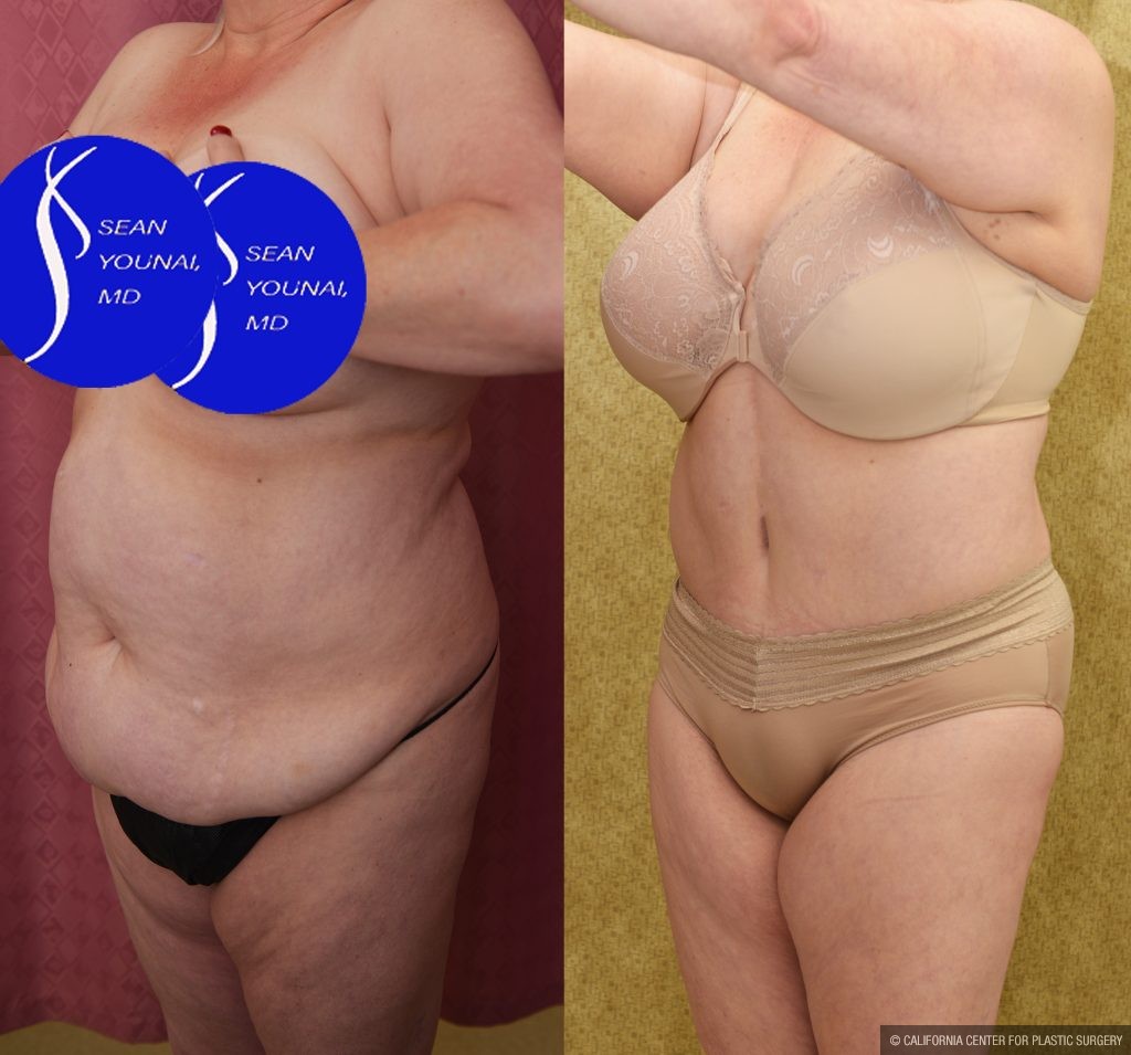 Tummy Tuck (Abdominoplasty) Plus Size Before & After Patient #14915