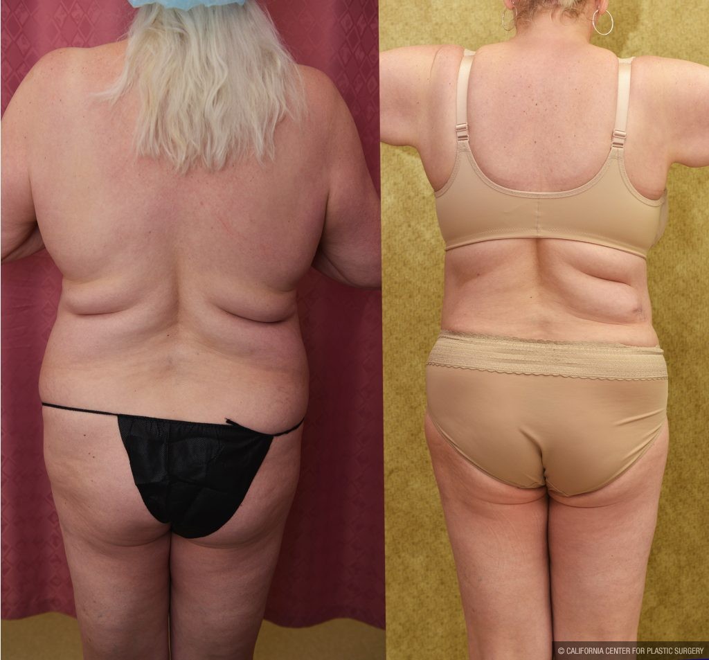Tummy Tuck (Abdominoplasty) Plus Size Before & After Patient #14915
