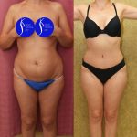 Tummy Tuck (Abdominoplasty) Small Size Before & After Patient #14917