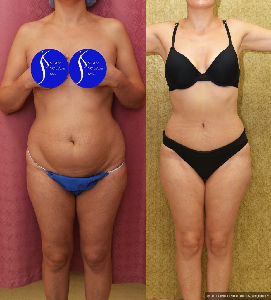 Tummy Tuck (Abdominoplasty) Small Size Before & After Patient #14917
