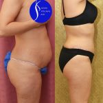 Tummy Tuck (Abdominoplasty) Small Size Before & After Patient #14917