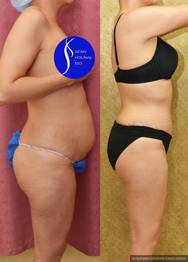 Tummy Tuck (Abdominoplasty) Small Size Before & After Patient #14917