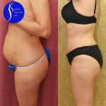 Tummy Tuck (Abdominoplasty) Small Size Before & After Patient #14917