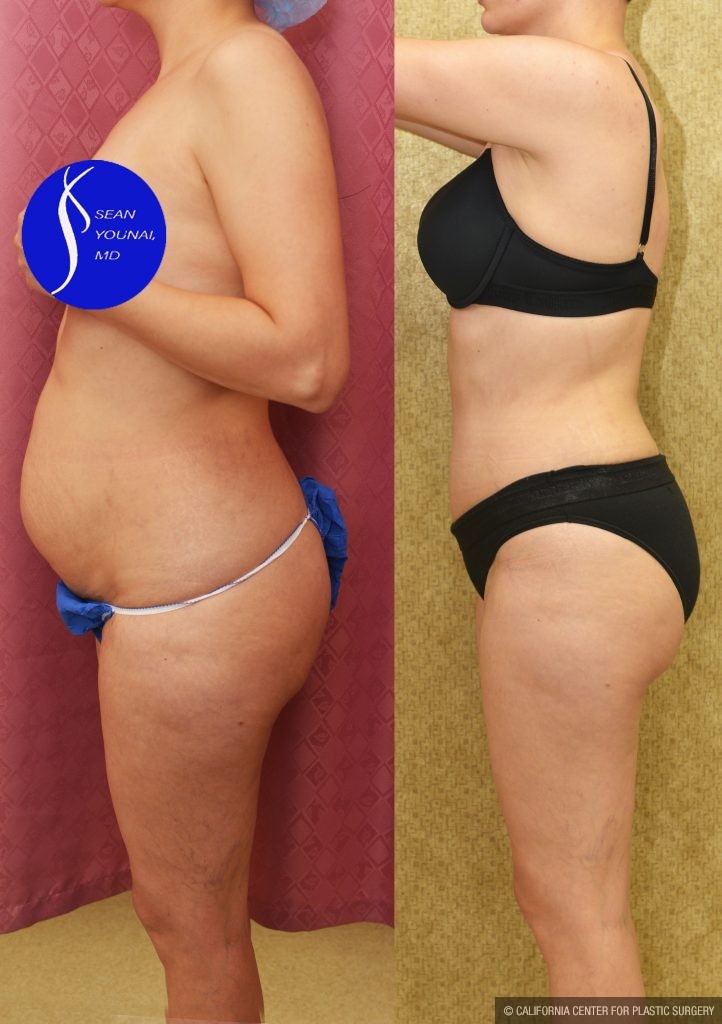 Tummy Tuck (Abdominoplasty) Small Size Before & After Patient #14917