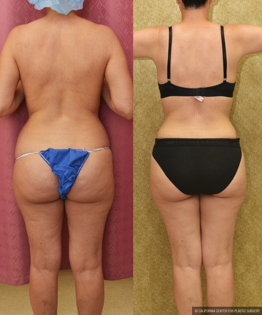 Tummy Tuck (Abdominoplasty) Small Size Before & After Patient #14917