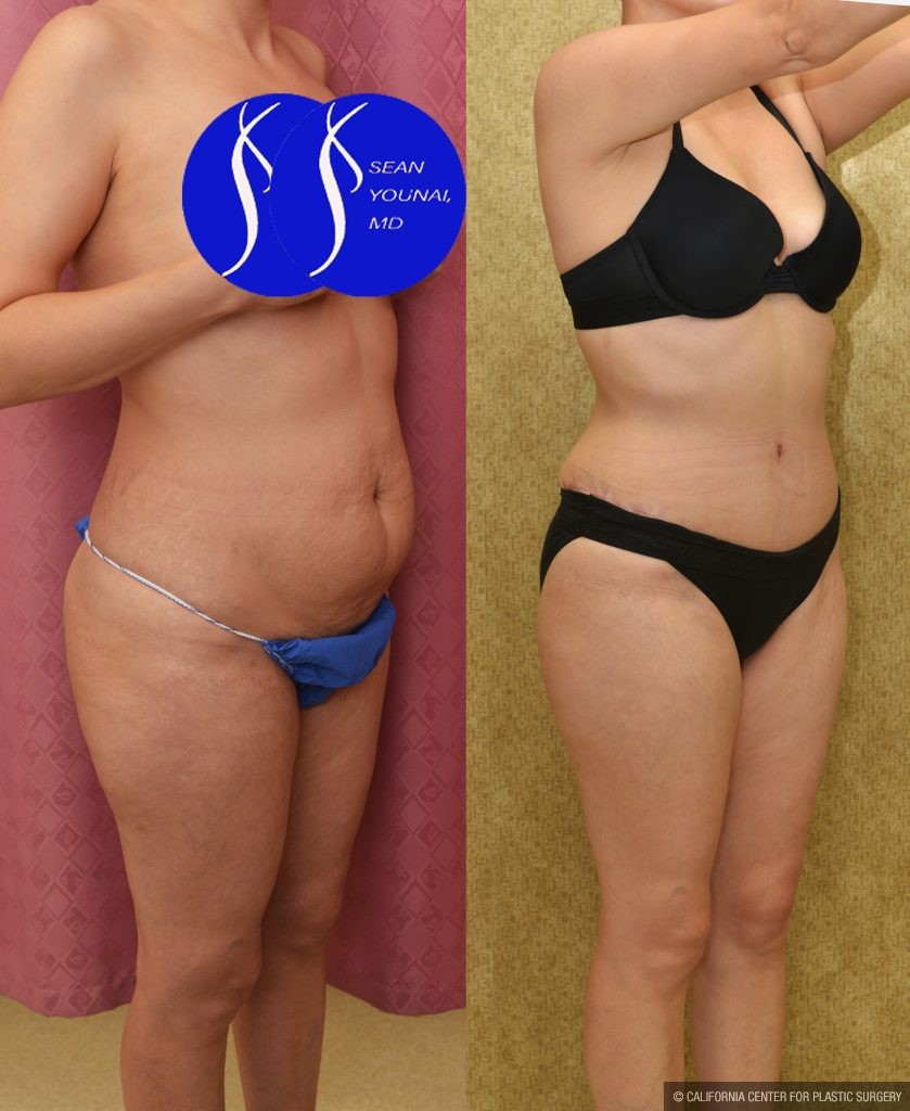 Tummy Tuck (Abdominoplasty) Small Size Before & After Patient #14917