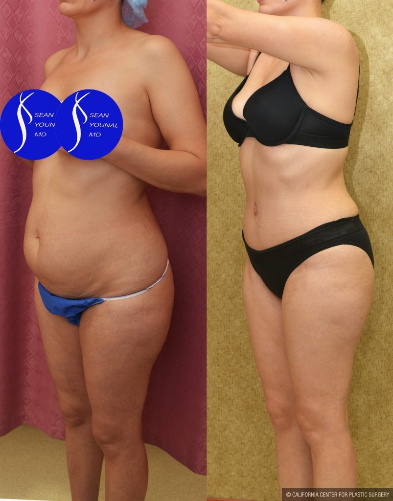 Tummy Tuck (Abdominoplasty) Small Size Before & After Patient #14917