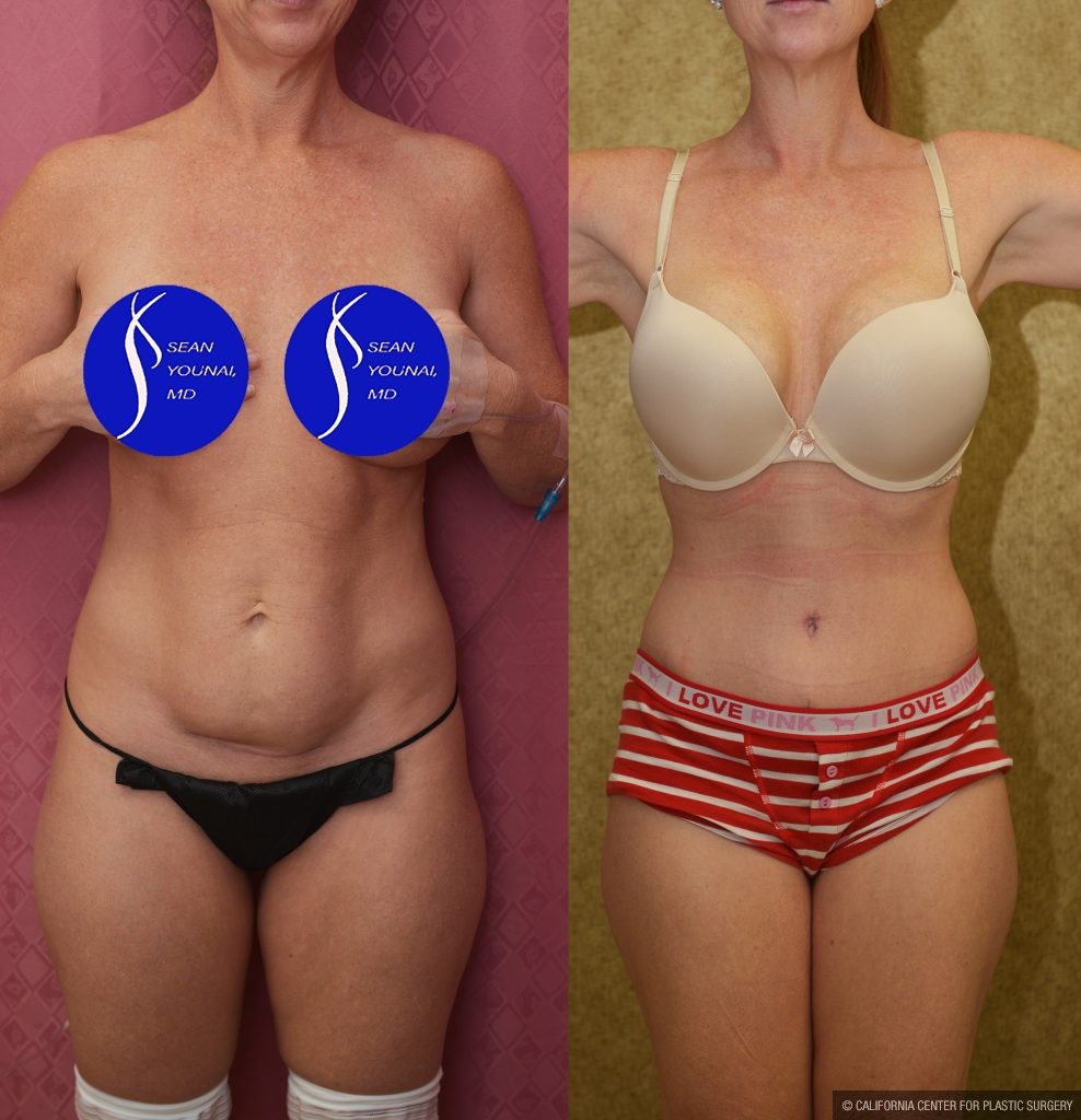 Tummy Tuck (Abdominoplasty) Small Size Before & After Patient #14918