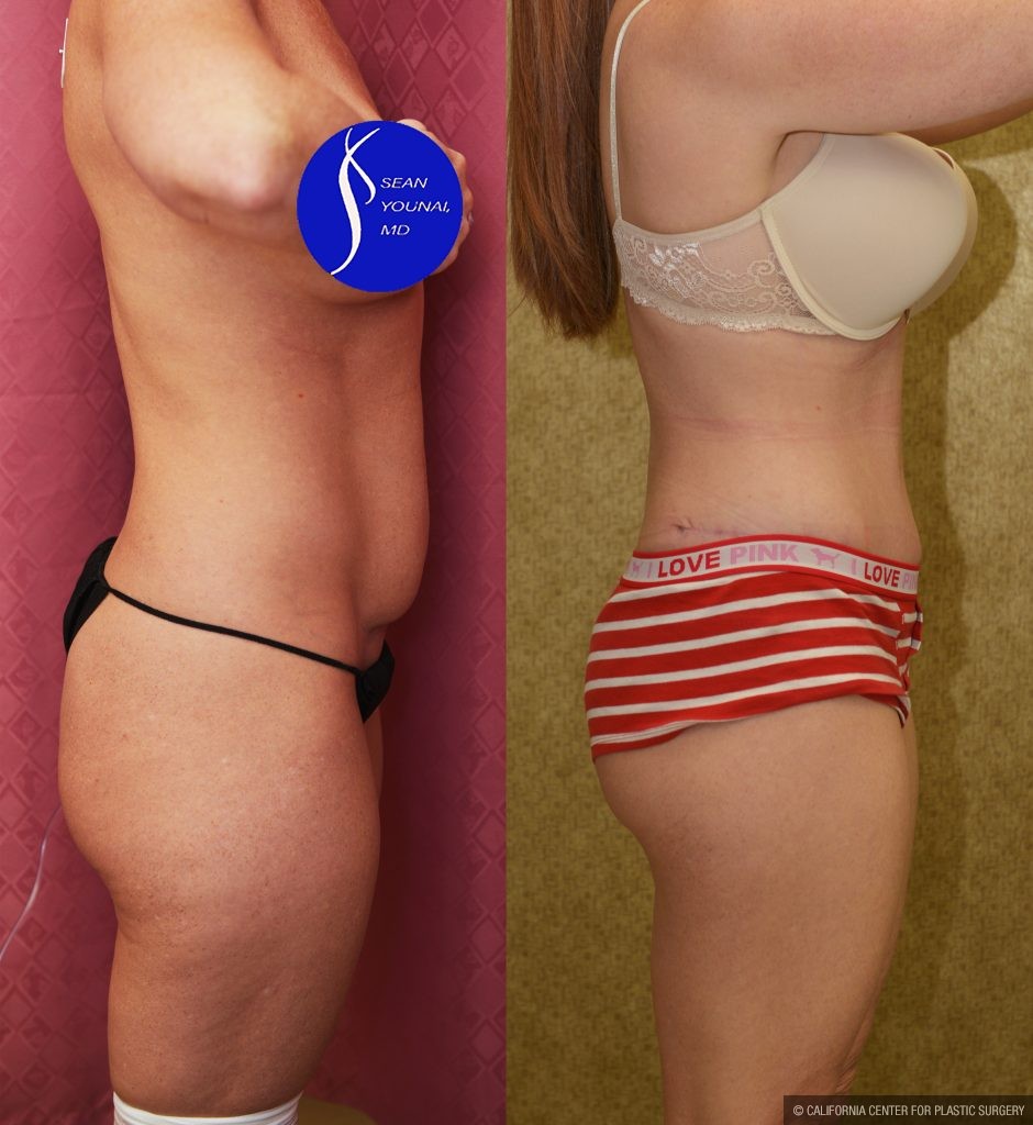 Tummy Tuck (Abdominoplasty) Small Size Before & After Patient #14918