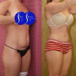 Tummy Tuck (Abdominoplasty) Small Size Before & After Patient #14918